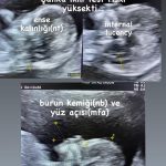 Ayrıntılı ultrason