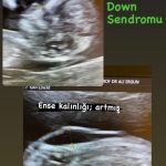 Ayrıntılı ultrason down sendromu